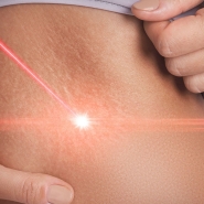 laser-stretch-mark-removal-featured-image-royal-beauty-miami